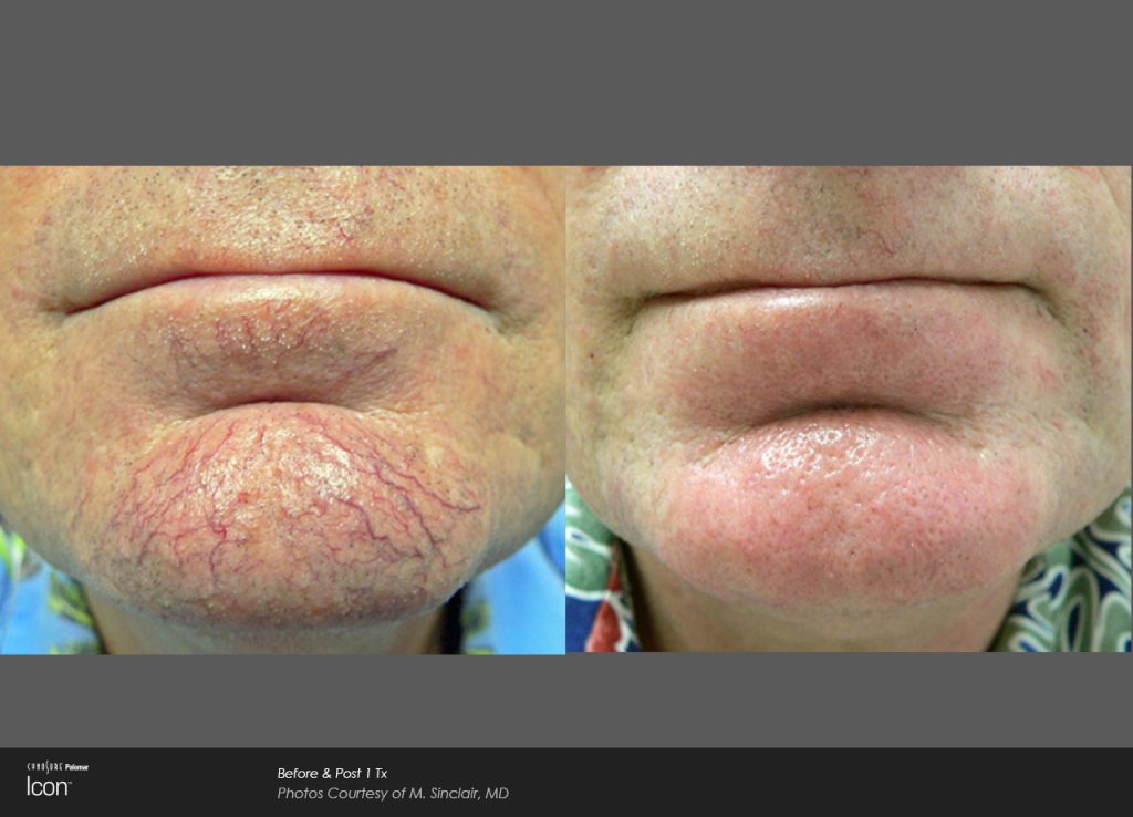 Skin-Revitalization-Before-&-After-Photo-3 | Colorado Laser Spa